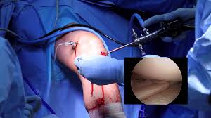Knee replacement procedure