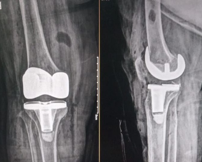 Cruciate Retaining Knee Joint Replacement