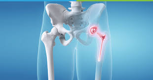 Revision Hip and Knee Replacement